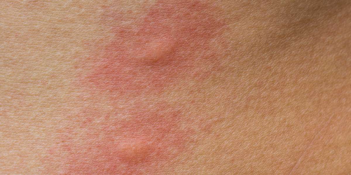 What is contact dermatitis? Types, Causes and Preventing