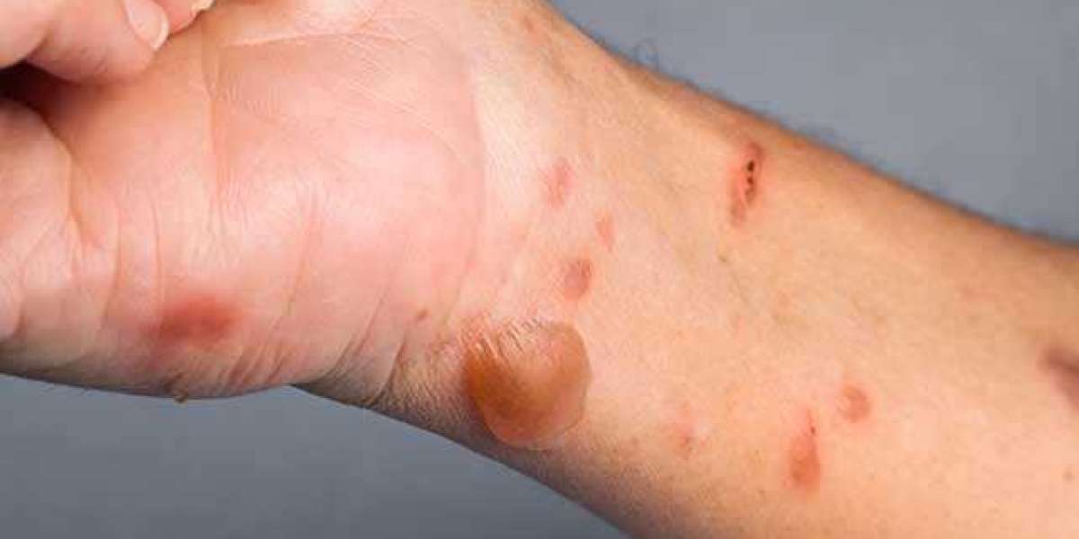 How Long Do Small Burns And Injuries Take To Heal?