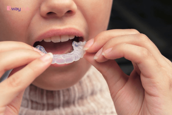 Top 9 lợi ích khi niềng răng trong suốt cho bé cần biết - Iway Club