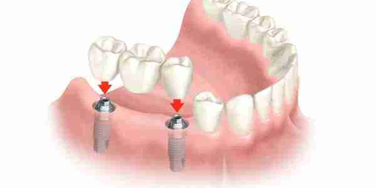 Địa chỉ làm răng Implant uy tín tại hà nội - nha khoa home