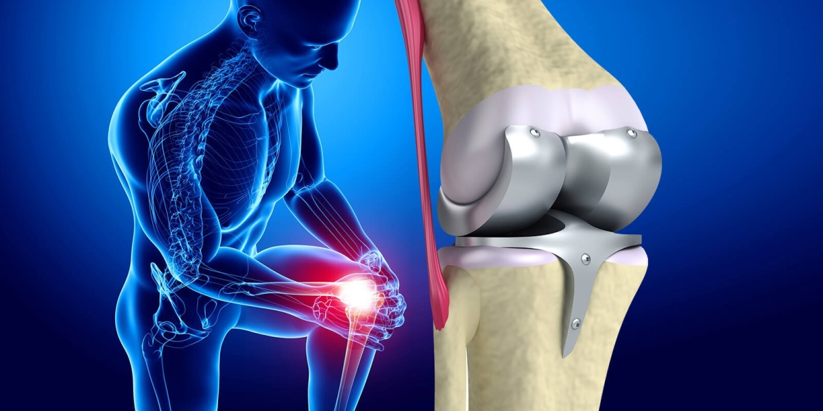 New Product Launches to Spur the Industry; Knee Replacement Market Insights Shows