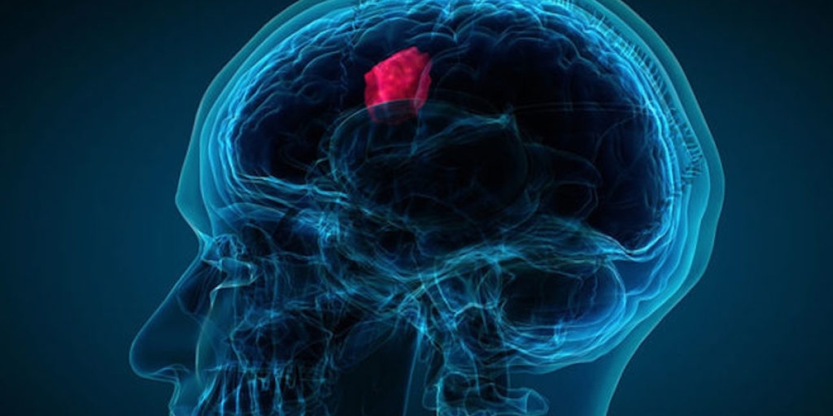 Pediatric Brain Tumor Market Insights States the Industry to Be Reinvigorated by a 6.8% CAGR By 2030