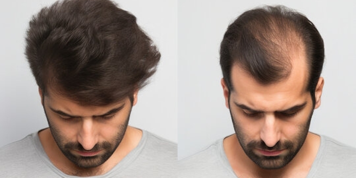 How to stop Hair Loss and Baldness (Benefits for Hair Growth)