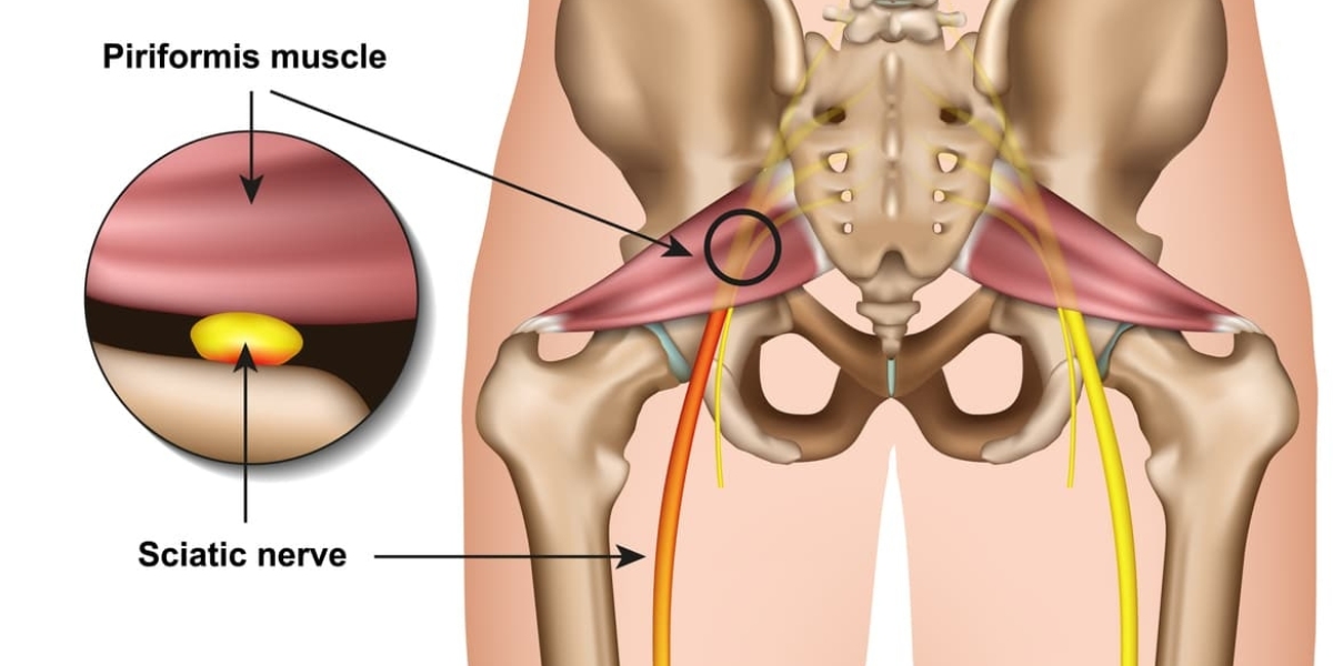 Sciatica Market Size : Epidemiology, Industry Trends, Opportunity and Forecast till 2023-2033