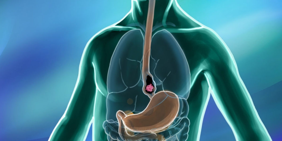 2023, Esophageal Cancer Market Research Report Analysis by 2033