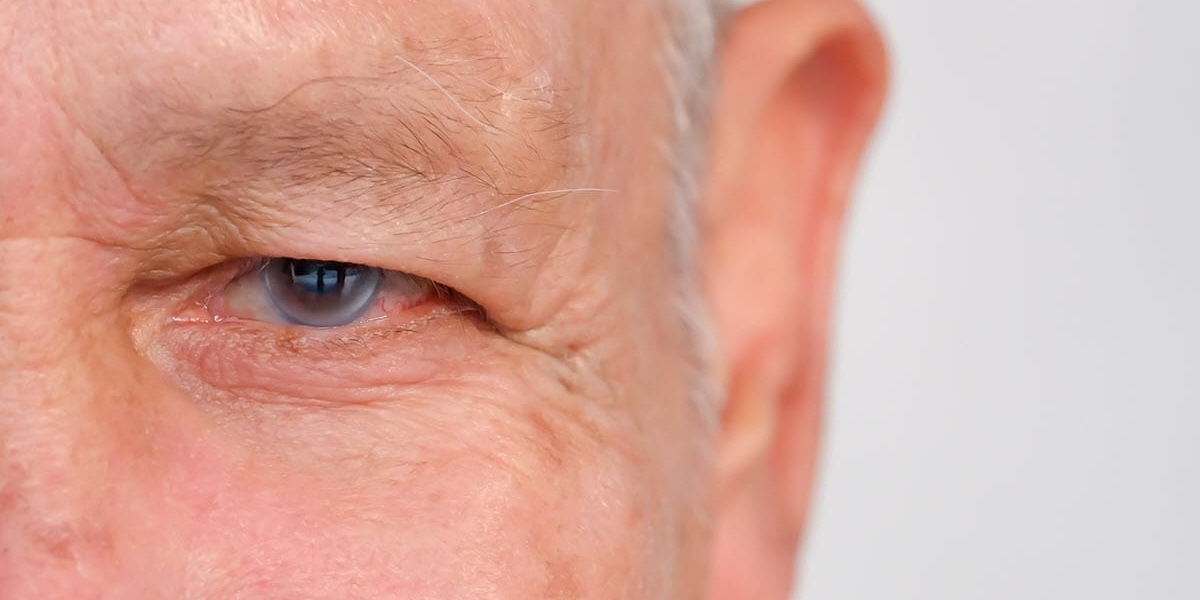 GLAUCOMA IN OLDER ADULTS