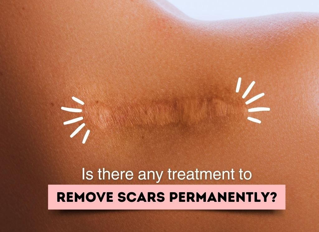 Is there any treatment to remove scars permanently? | TrulyPpermanent Beauty