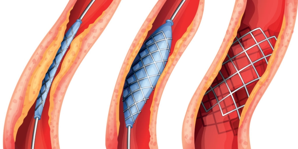 Exploring the Global Lung Stent Market: Key Trends, Analysis, and Geographical Insights