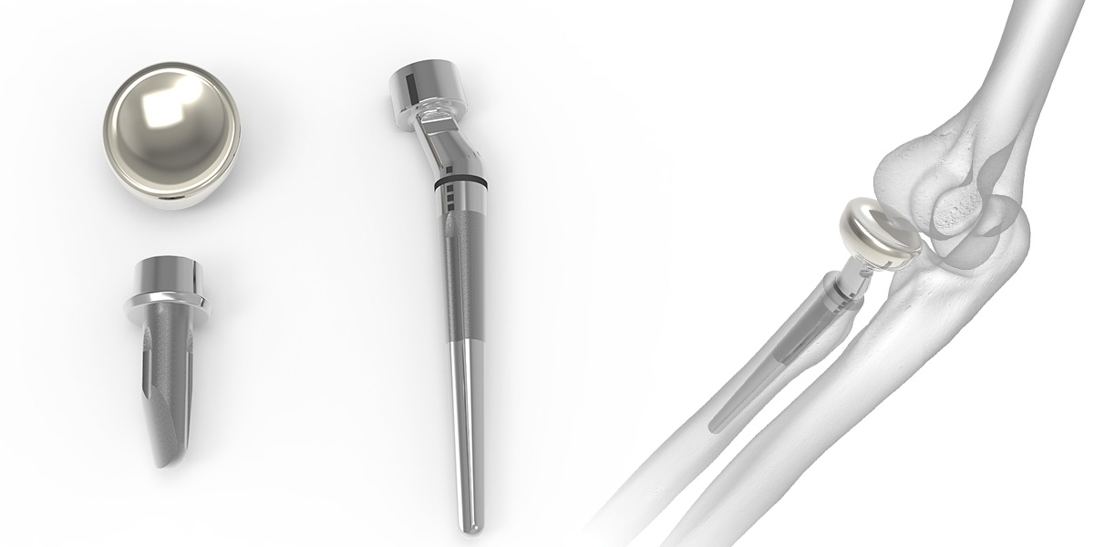 Radial Head Resection Implants Market: A Comprehensive Analysis