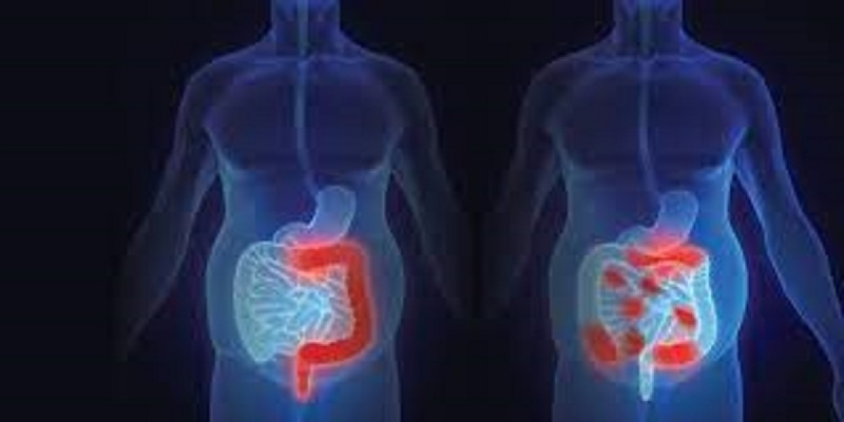 Crohn's Disease Market Analysis, Epidemiology, Trends and Forecast till (2024-2034)