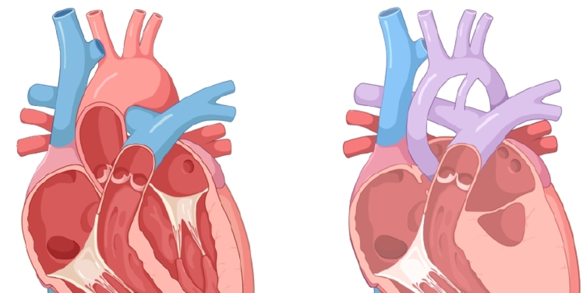 2024 Hypoplastic Left Heart Syndrome Market | Report By 2034