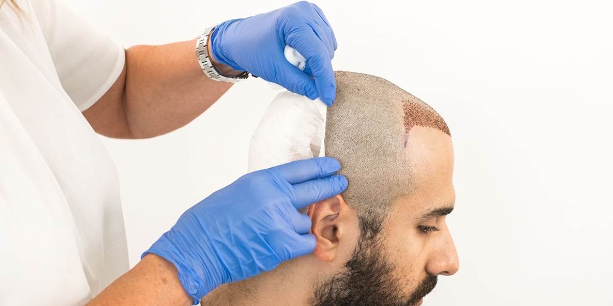 Emerging Trends In The Global Hair Transplant System Market