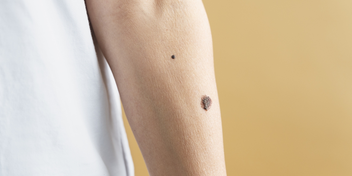 Don't Ignore the Signs: Understanding Skin Cancer Symptoms for Early Intervention