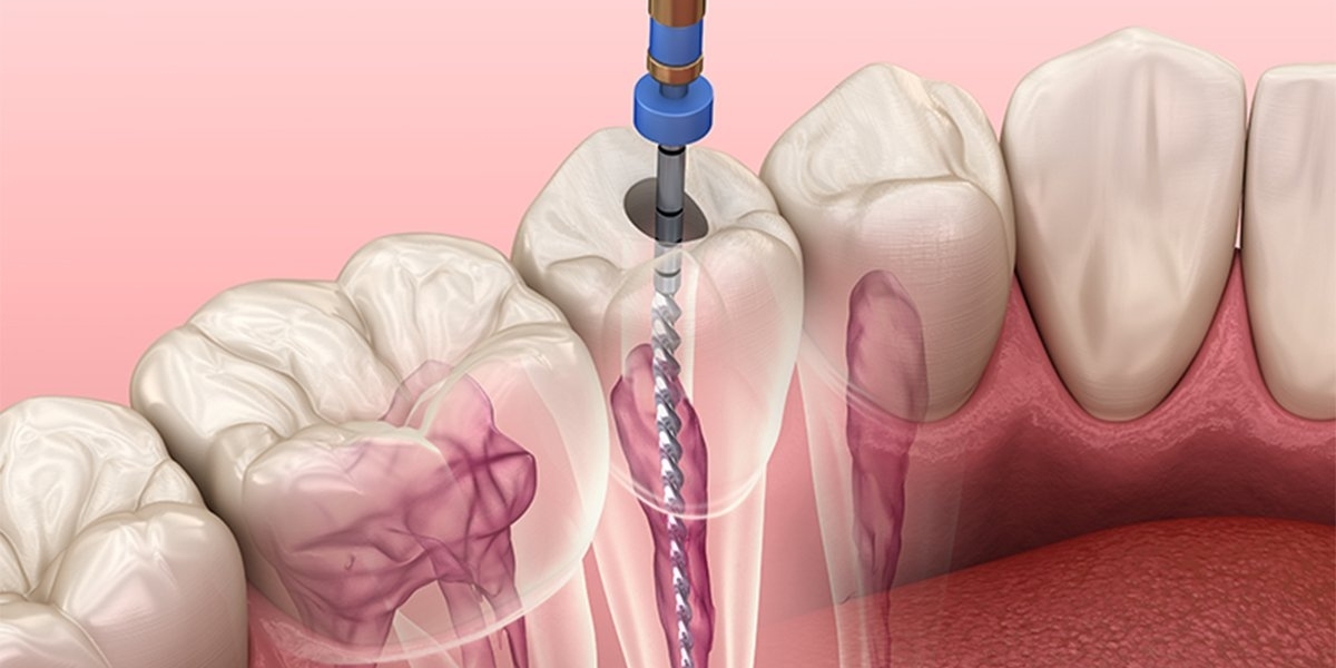 Optimizing Root Canal Files: Strategies for Success