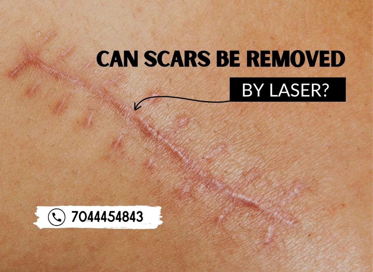 Can scars be removed by laser? | Truly Permanent Beauty