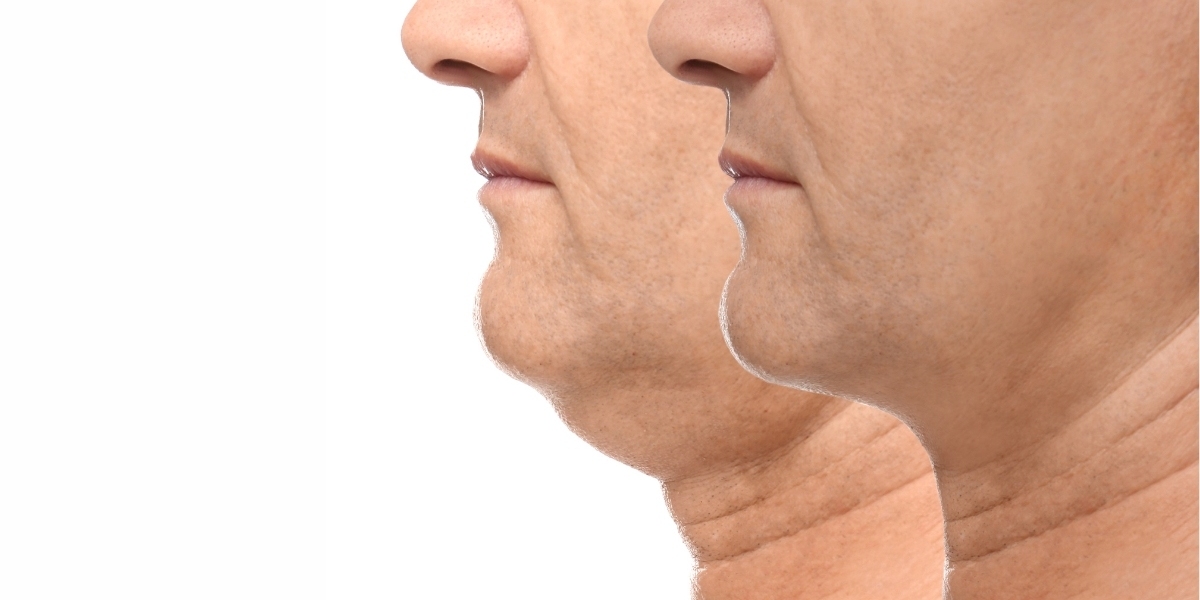 Long-Term Results of Double Chin Removal in Dubai
