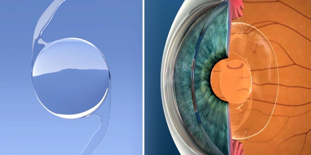 Seeing Clearly Again: Intraocular Lens Implants Illuminate the Path to Better Vision