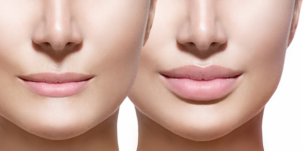 Lip Augmentation in Dubai Common Myths and Misconceptions