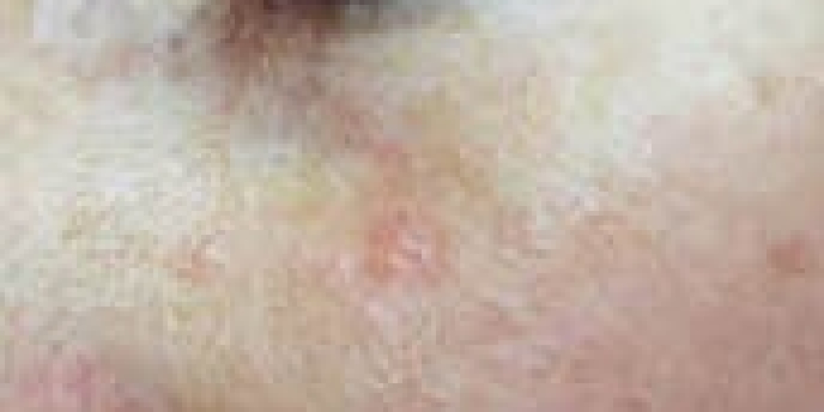 Basal Cell Carcinoma Market Trends: Epidemiology, Size, Share, Analysis and Forecast till (2024-2034)