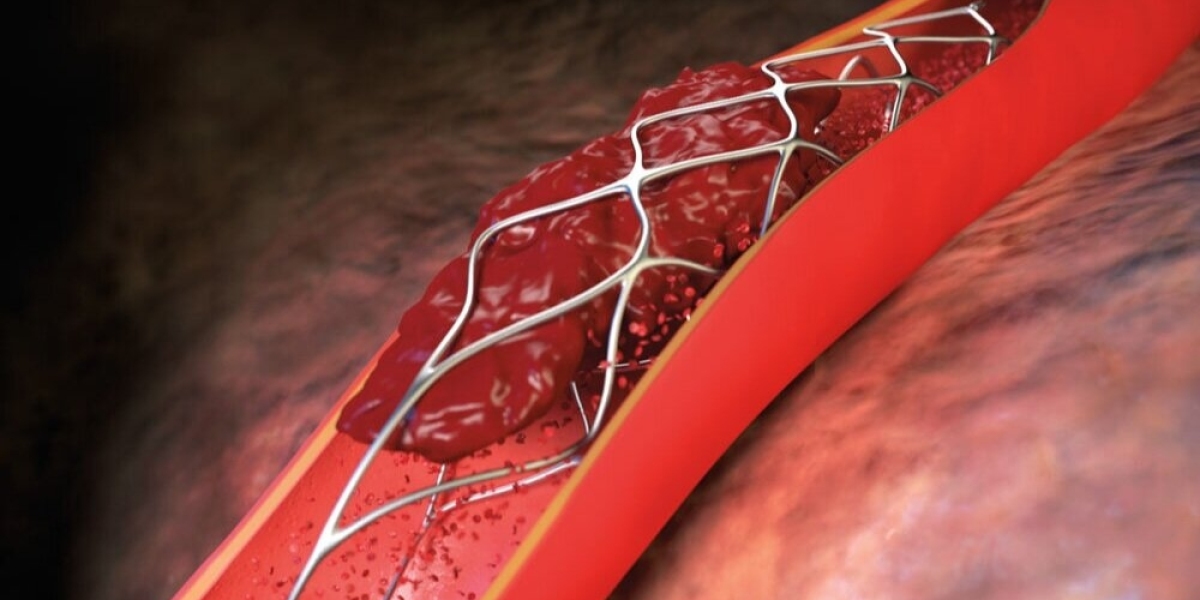 Lung Stent Industry: Robust Expansion Ahead Based on Growing Prevalence of Lung Diseases